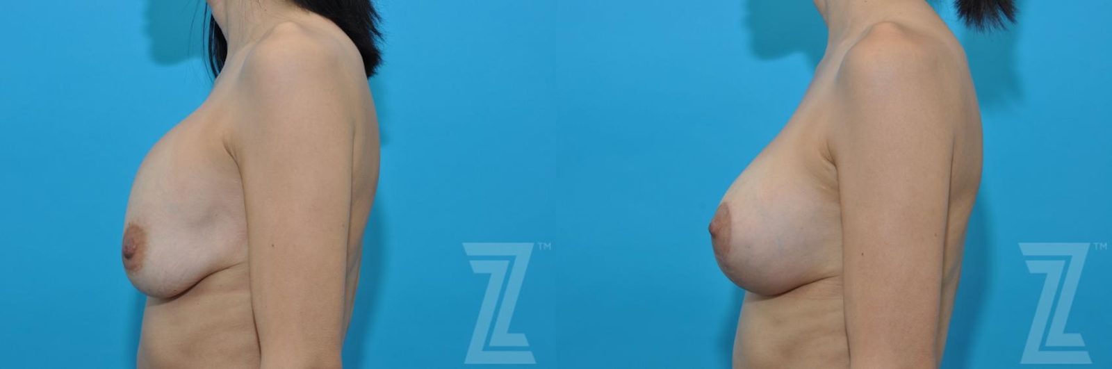 Austin Breast Augmentation Revision Before & After Gallery - Patient 132886578 - Image 2 - The Piazza Center