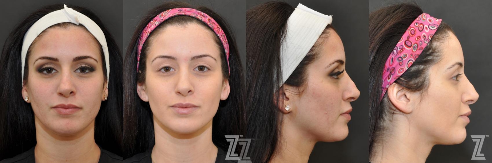 Austin Chemical Peel Before & After Gallery - Patient 132963250 - Image 1 - The Piazza Center