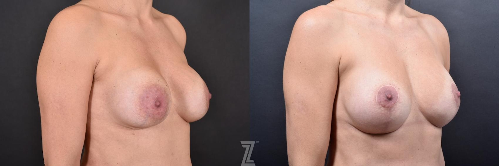Austin Breast Augmentation Revision Before & After Gallery - Patient 132886593 - Image 4 - The Piazza Center