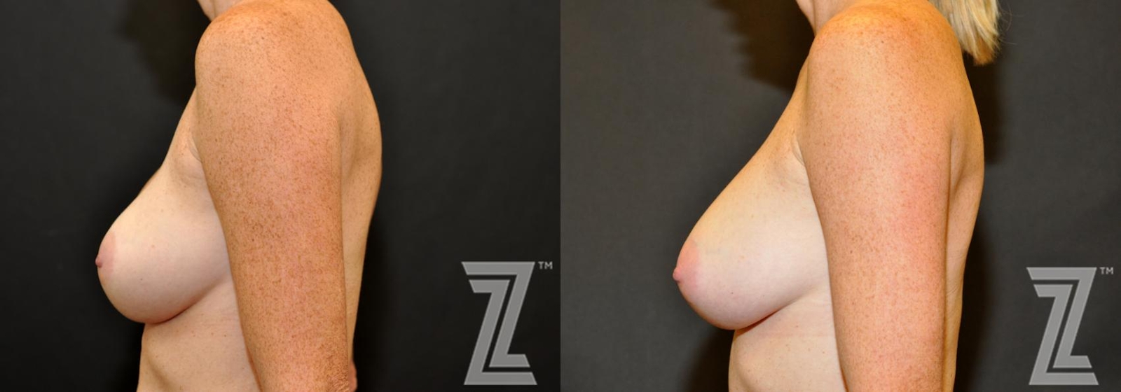 Austin Breast Augmentation Revision Before & After Gallery - Patient 132886587 - Image 3 - The Piazza Center