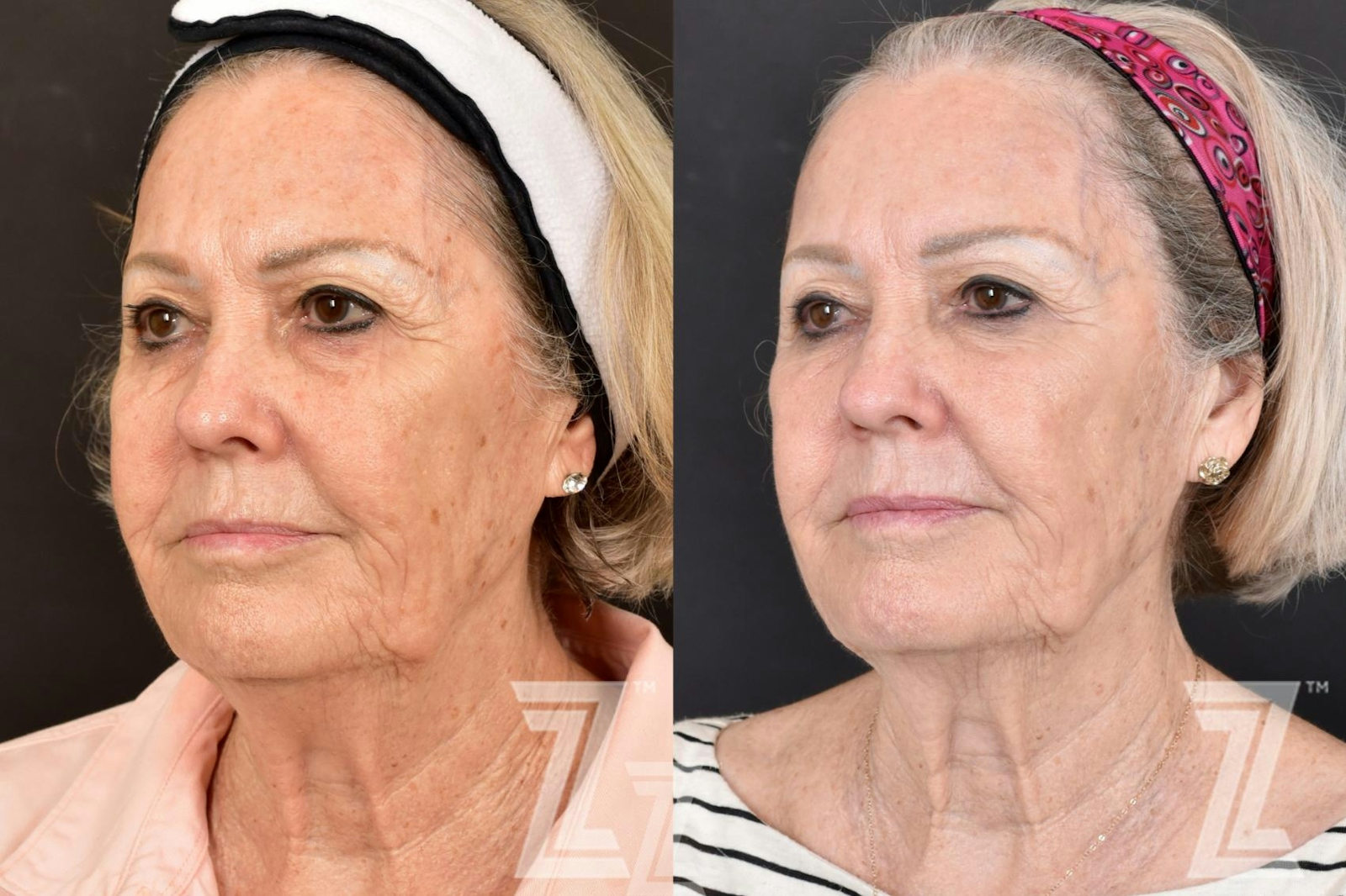 Austin HALO Before & After Gallery - Patient 132963261 - Image 2 - The Piazza Center
