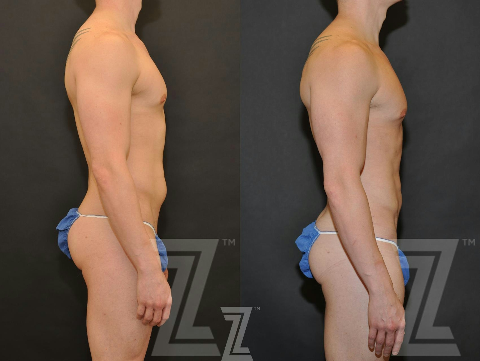 Austin Male Body Contouring Before & After Gallery - Patient 174118 - Image 5 - The Piazza Center