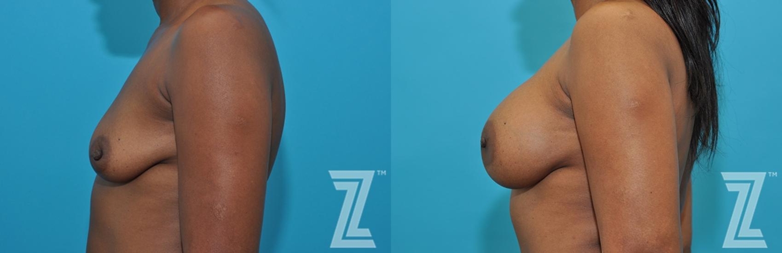 Austin Lateral breast view of 43-year-old mother of two mommy maker over - Dr. Rocco Piazza - The Piazza Center