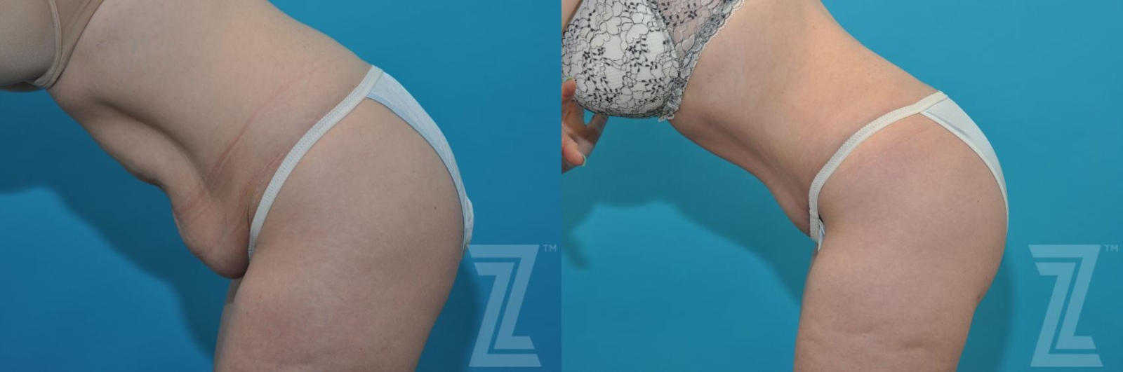 Austin Tummy Tuck Before & After Gallery - Patient 132886814 - Image 3 - The Piazza Center