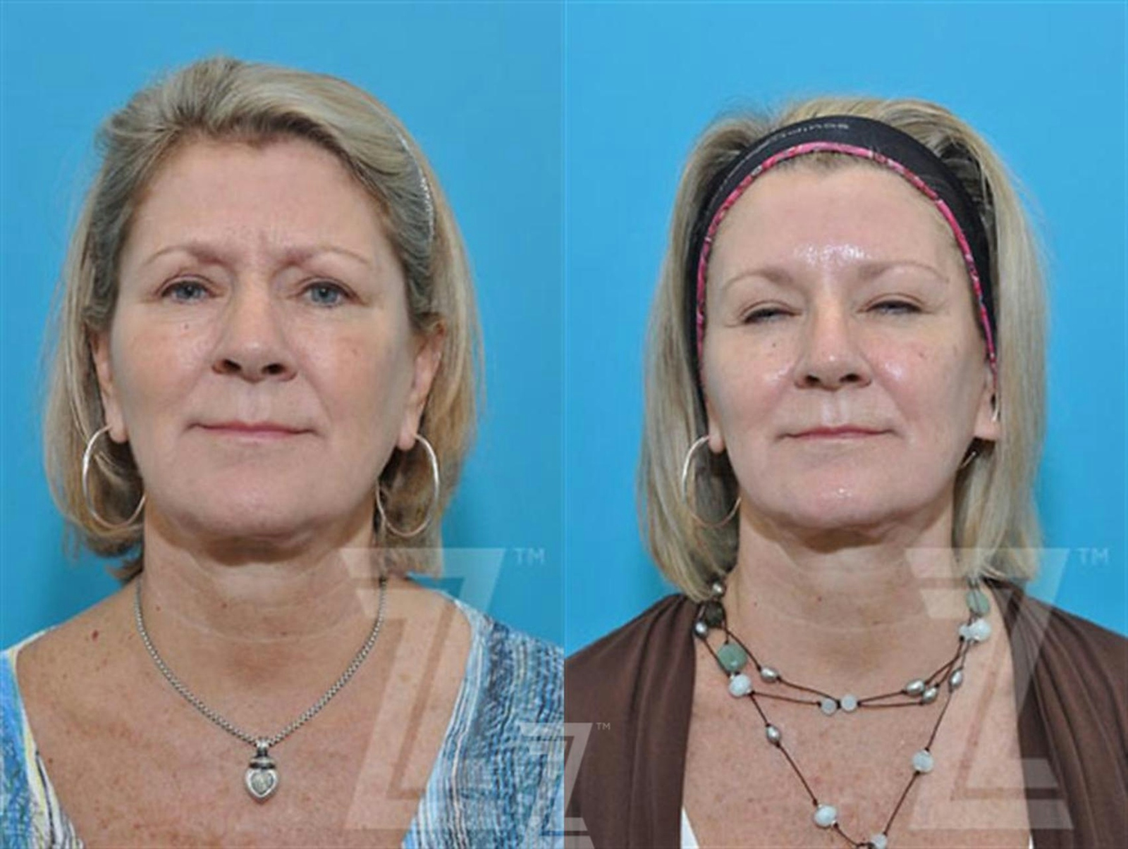 Austin Wrinkle Relaxers Before & After Gallery - Patient 132906316 - Image 2 - The Piazza Center
