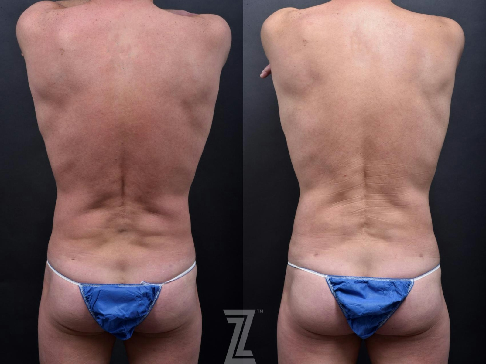 Austin Male Body Contouring Before & After Gallery - Patient 173307 - Image 3 - The Piazza Center