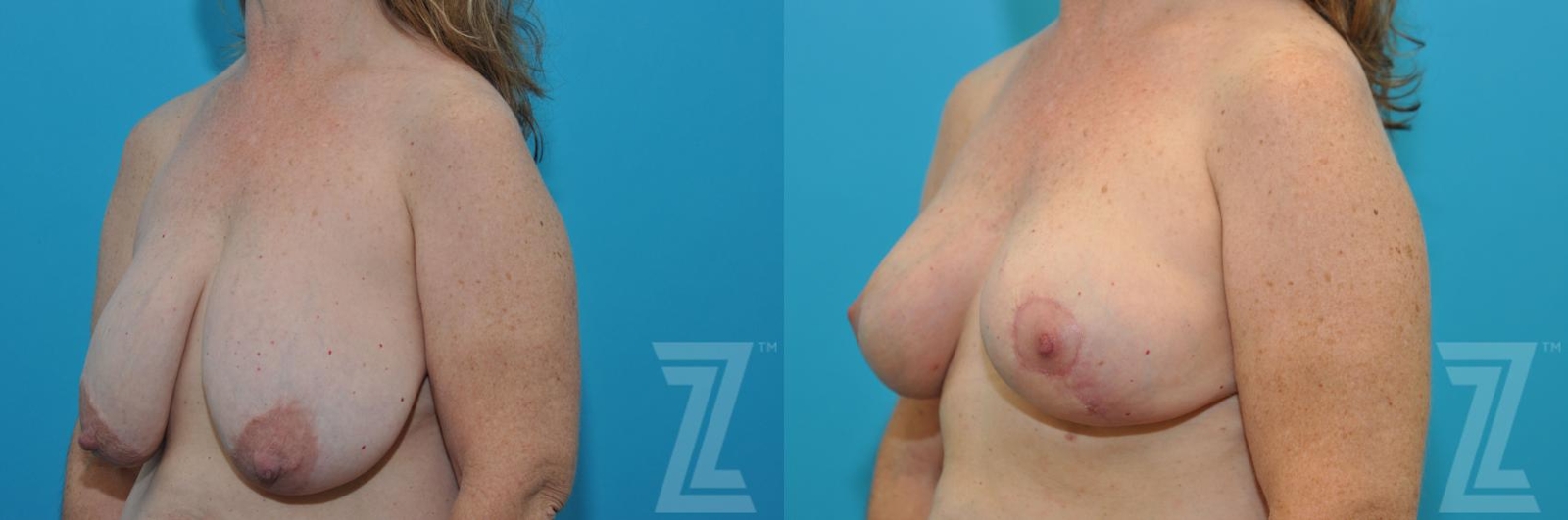 Austin Breast Reduction Before & After Gallery - Patient 132886744 - Image 2 - The Piazza Center