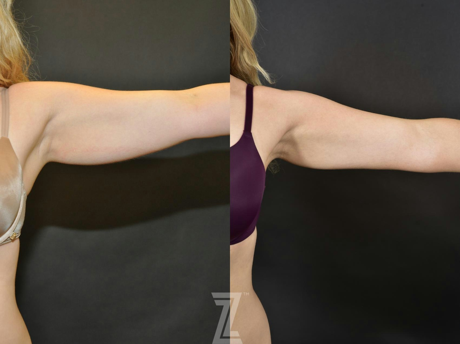 Austin CoolSculpting® Before & After Gallery - Patient 132905382 - Image 1 - The Piazza Center