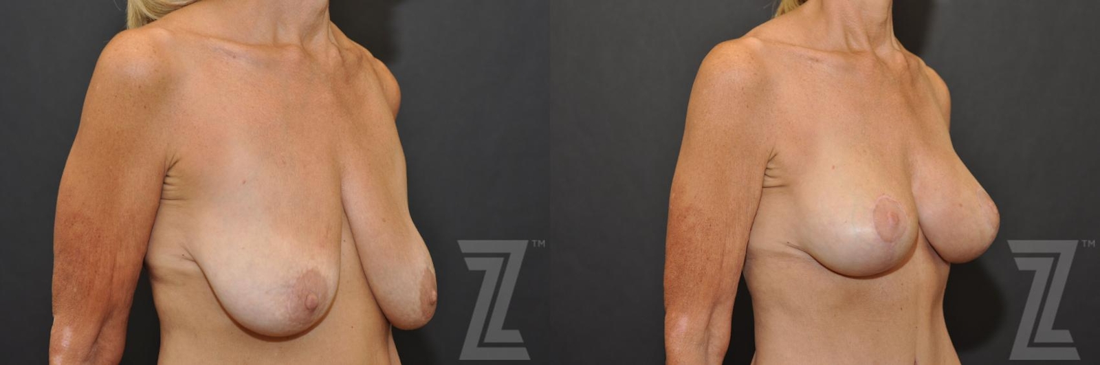 Austin Breast Augmentation With a Breast Lift Before & After Gallery - Patient 132793339 - Image 4 - The Piazza Center