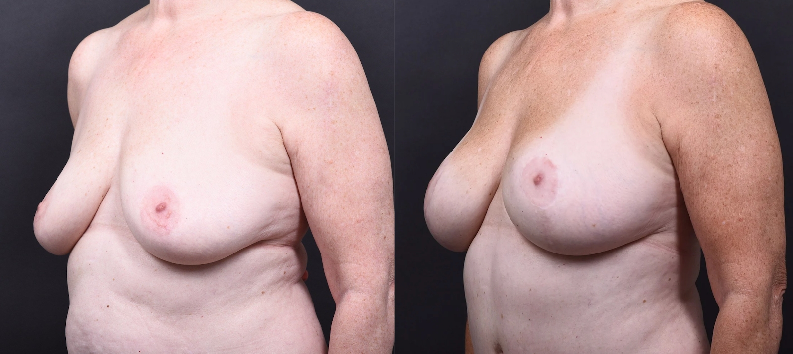 Austin Breast Augmentation With a Breast Lift Before & After Gallery - Patient 438571 - Image 4 - The Piazza Center