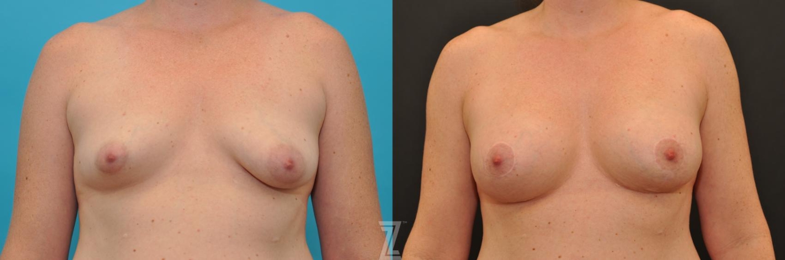 Austin Breast Augmentation With a Breast Lift Before & After Gallery - Patient 132791097 - Image 1 - The Piazza Center