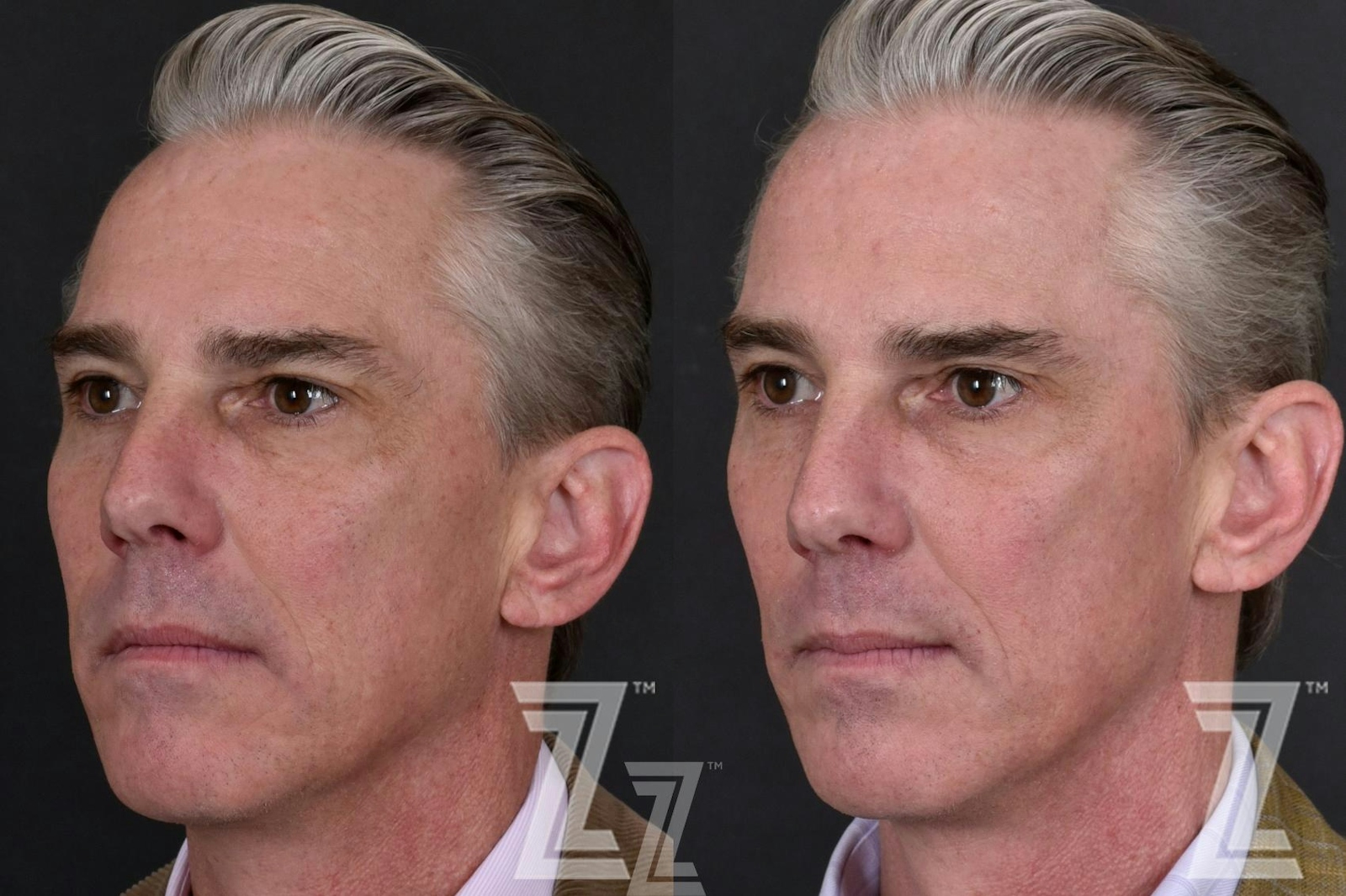 Austin HALO Before & After Gallery - Patient 132963262 - Image 2 - The Piazza Center