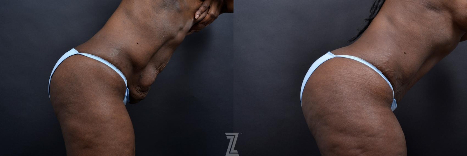 Austin 1 Year Post-OP Mommy Makeover in Austin, TX by Dr. Rocco Piazza - Lateral Abdomen View in Flexion - The Piazza Center