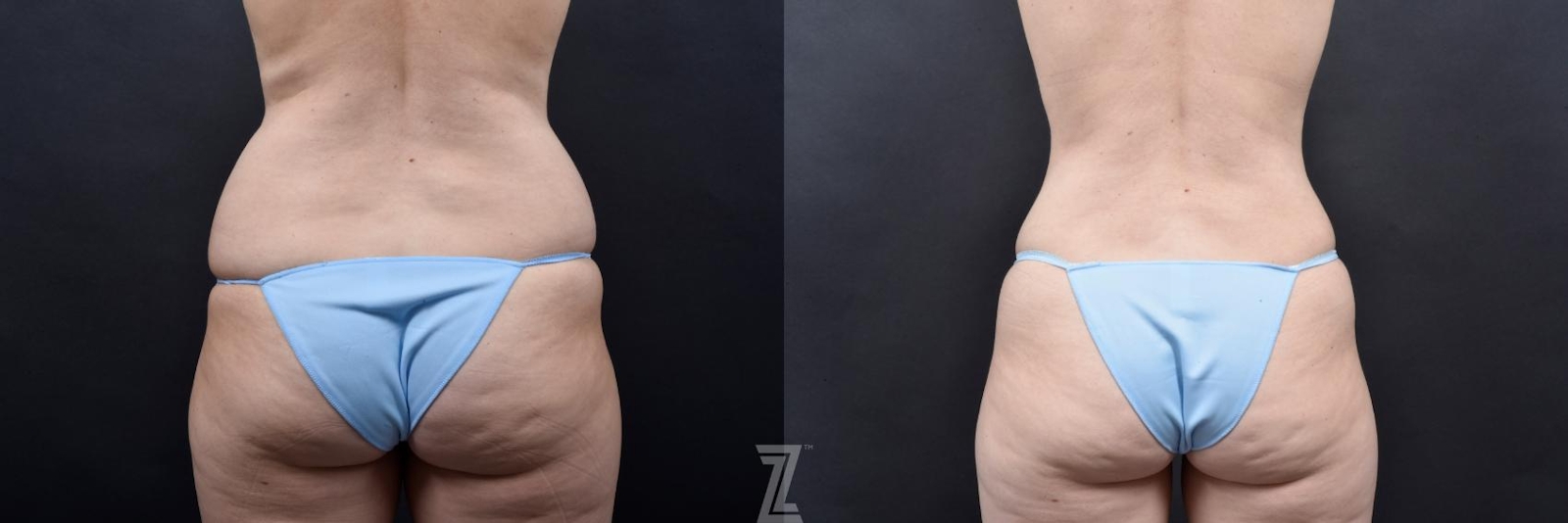 Austin Skin Pinch Before & After Gallery - Patient 132886936 - Image 6 - The Piazza Center