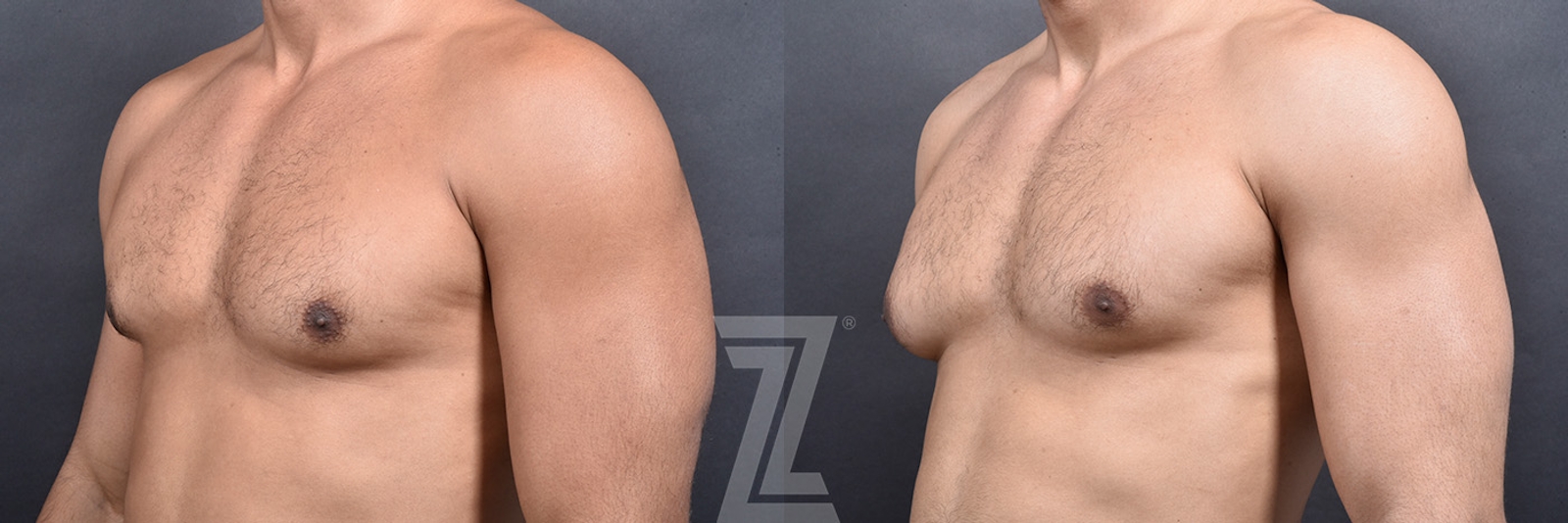 Austin Gynecomastia/Male Breast Reduction Before & After Gallery - Patient 377773 - Image 2 - The Piazza Center