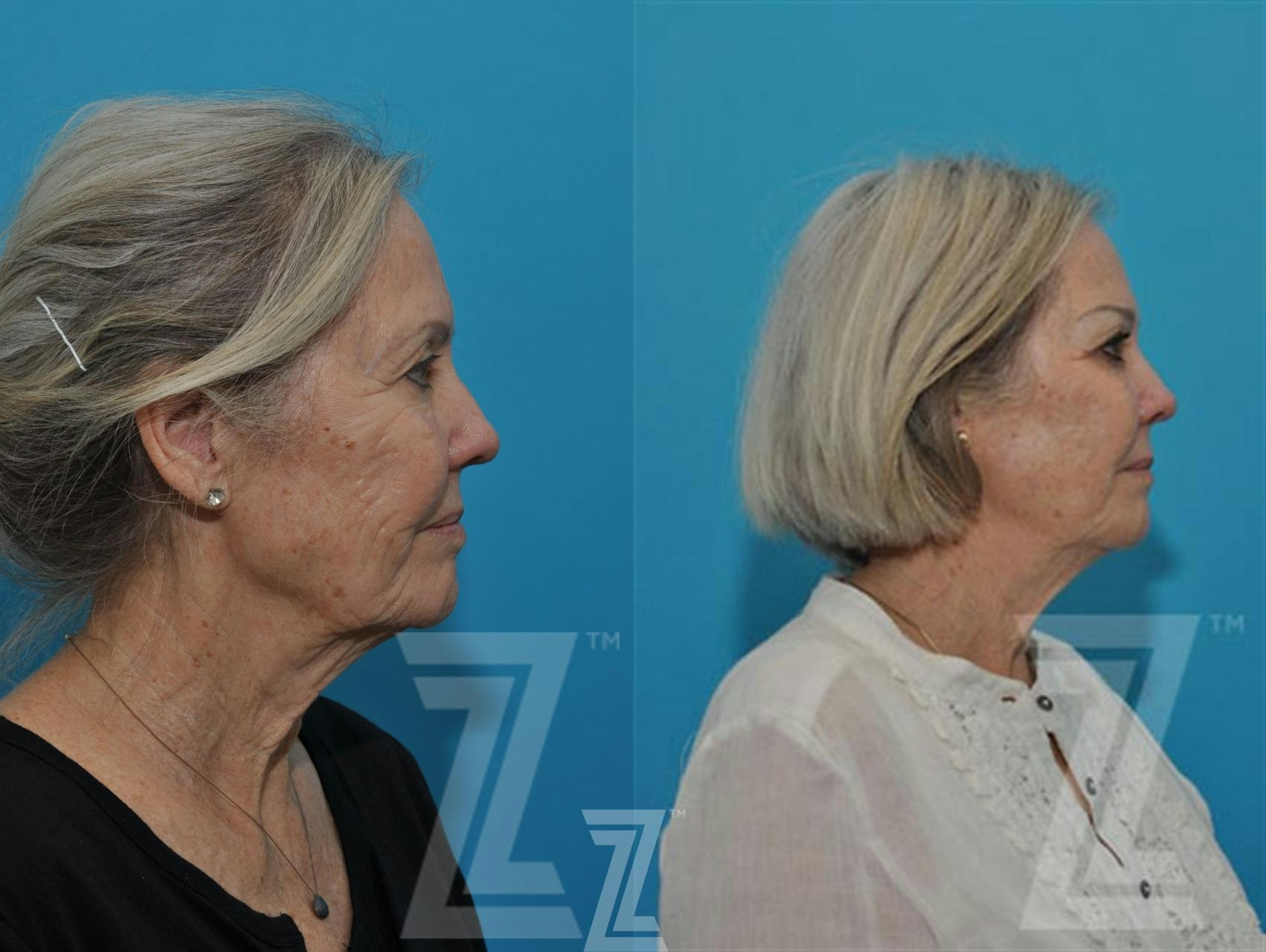 Austin Sculptra® Before & After Gallery - Patient 132963132 - Image 5 - The Piazza Center
