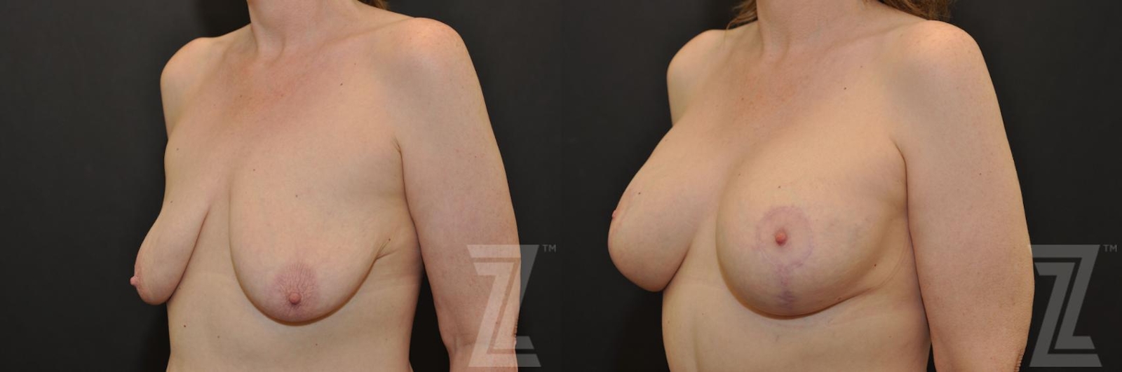Austin Breast Augmentation With a Breast Lift Before & After Gallery - Patient 132793338 - Image 2 - The Piazza Center