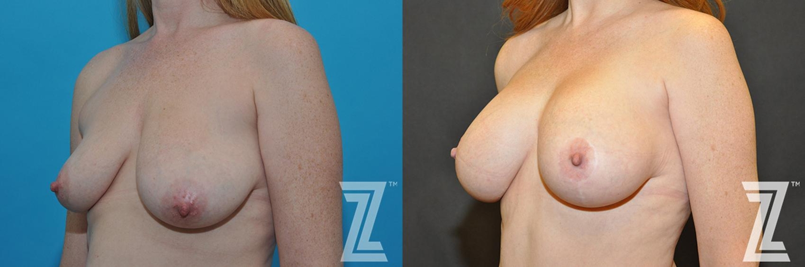Austin Correction of Breast Asymmetry Before & After Gallery - Patient 132886778 - Image 2 - The Piazza Center