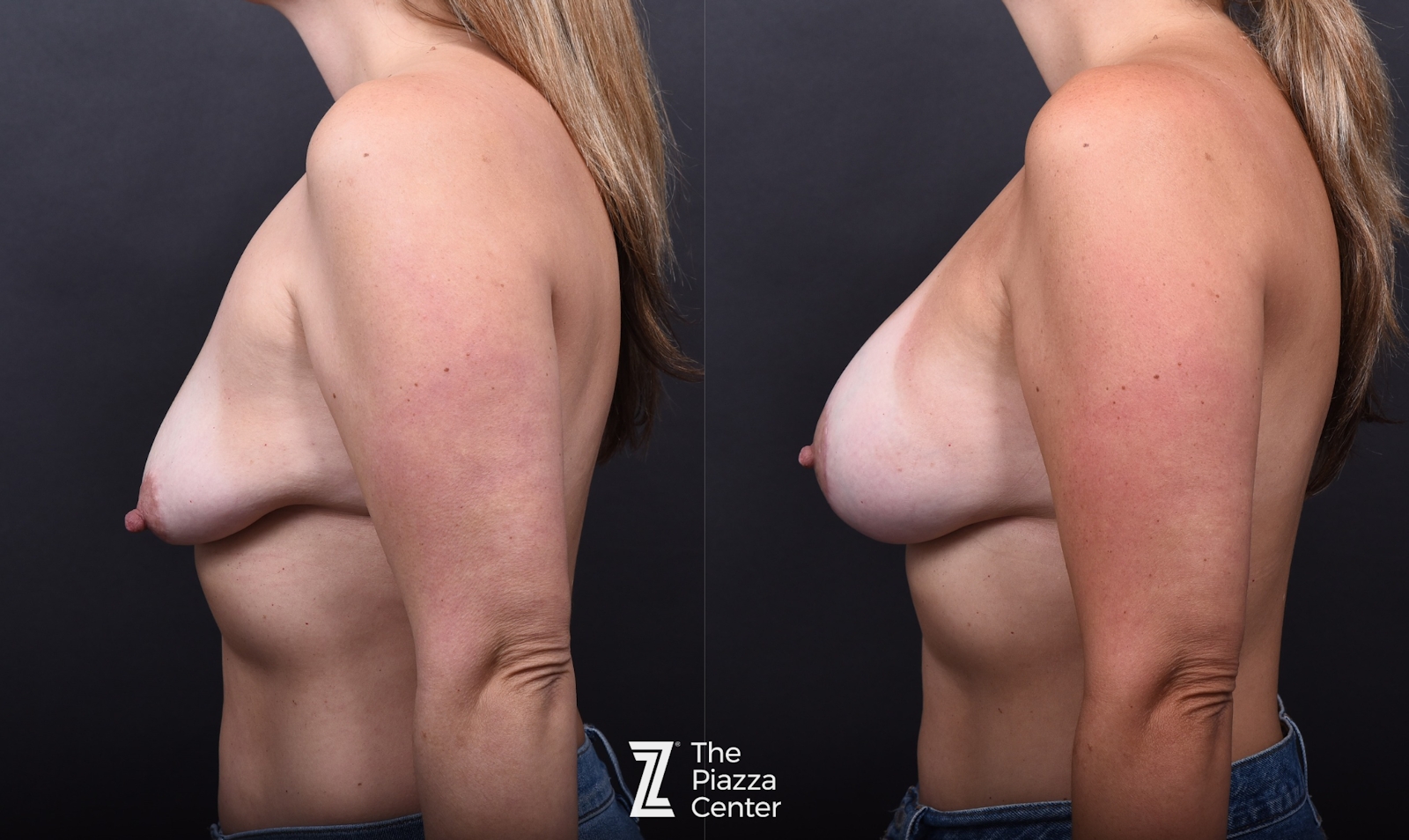 Austin Breast Augmentation Before & After Gallery - Patient 730444 - Image 5 - The Piazza Center