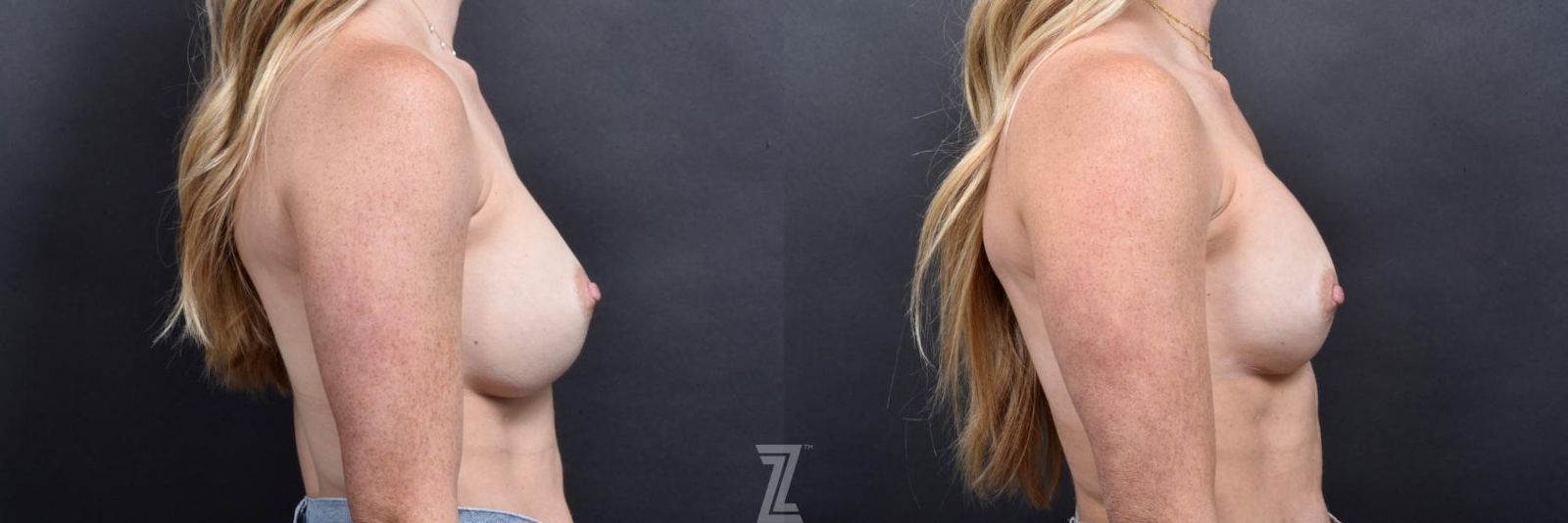 Austin Breast Augmentation Revision Before & After Gallery - Patient 132886589 - Image 5 - The Piazza Center