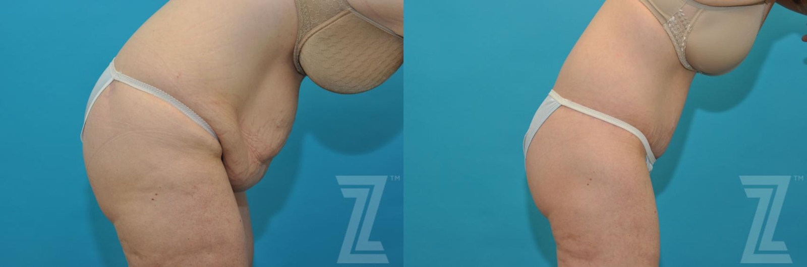 Austin Tummy Tuck Before & After Gallery - Patient 132886807 - Image 5 - The Piazza Center