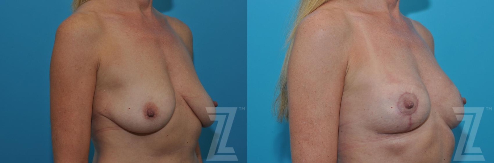 Austin Breast Lift Before & After Gallery - Patient 132791081 - Image 4 - The Piazza Center