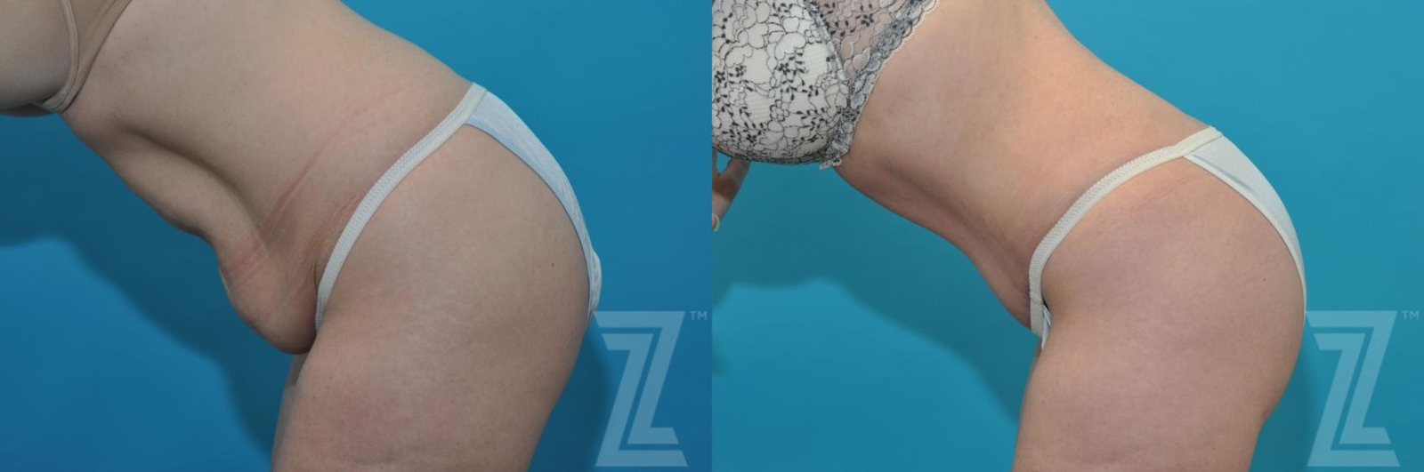 Austin Tummy Tuck Before & After Gallery - Patient 132886874 - Image 4 - The Piazza Center