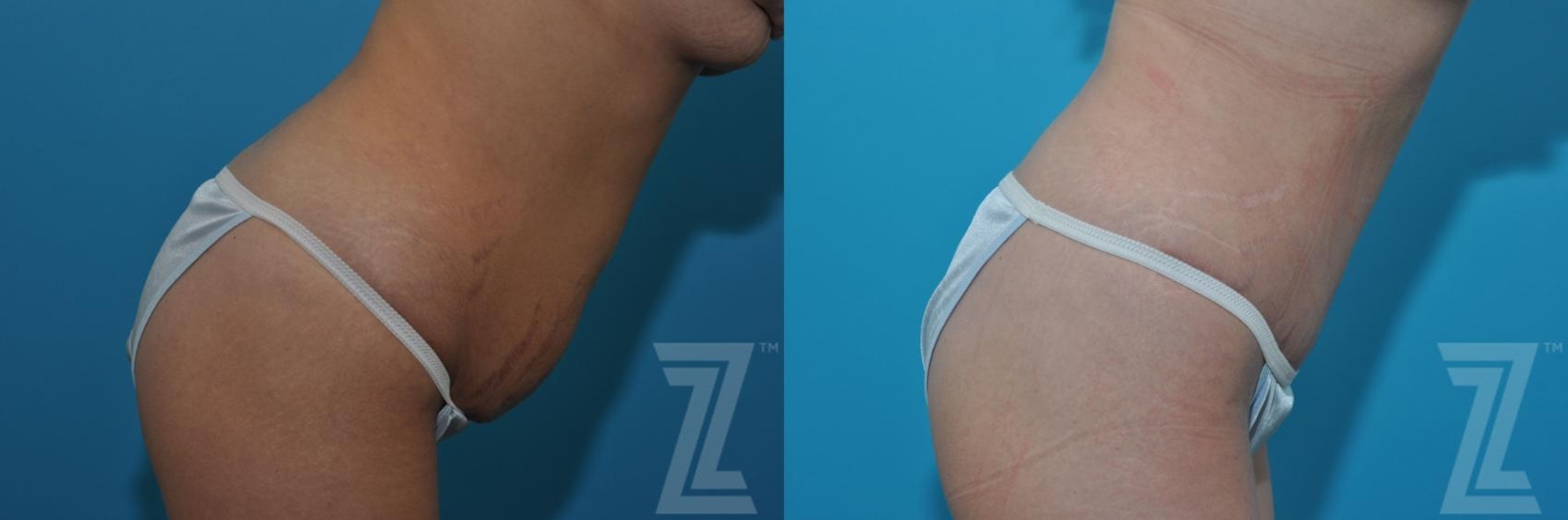 Austin Tummy Tuck Before & After Gallery - Patient 132886879 - Image 5 - The Piazza Center