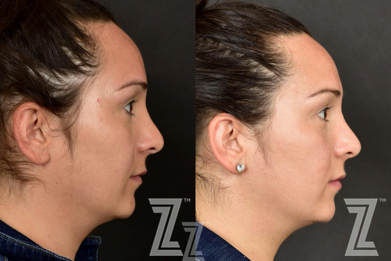 Austin HALO Before & After Gallery - Patient 132963258 - Image 3 - The Piazza Center