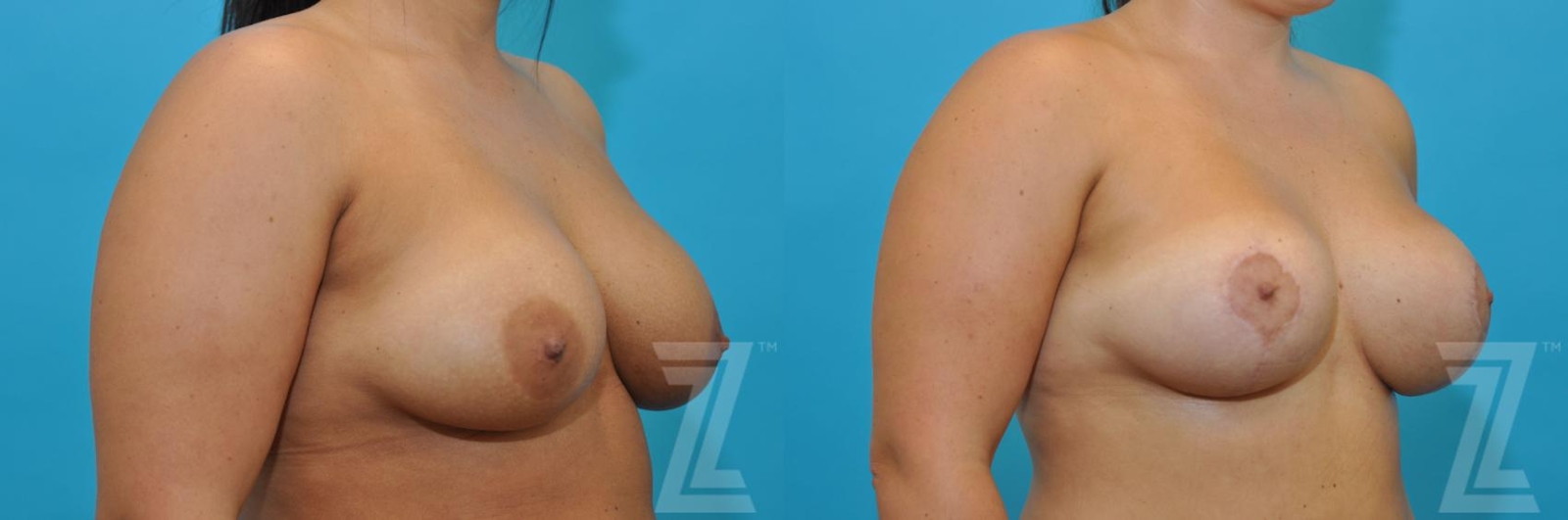Austin Breast Augmentation Revision Before & After Gallery - Patient 132886591 - Image 4 - The Piazza Center