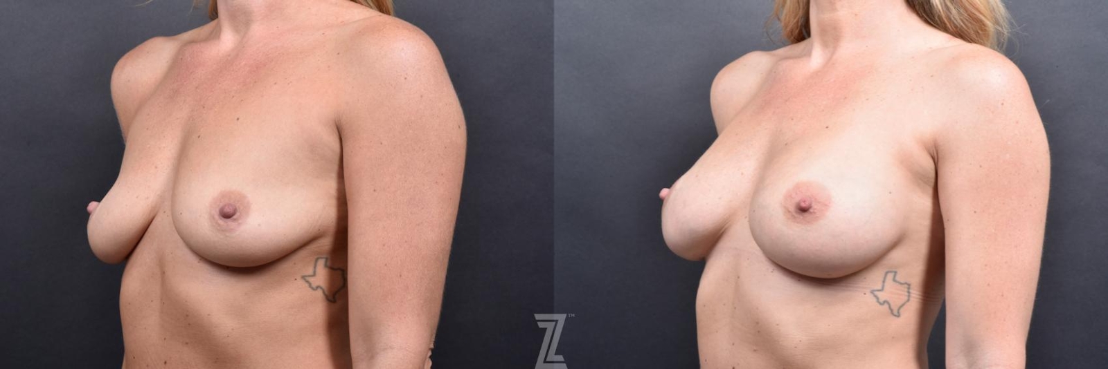 Austin Oblique view Before & After of 36 Year old woman breast augmentation - Piazza Center - The Piazza Center