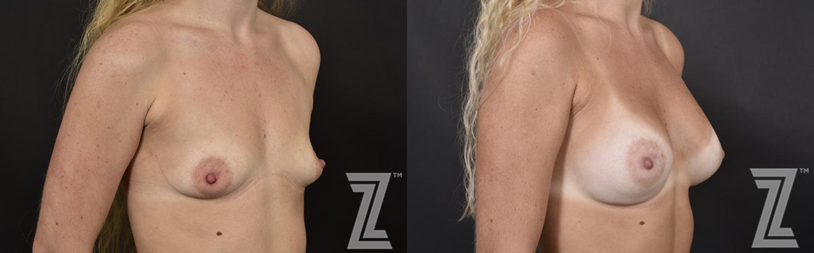 Austin Oblique view of before and after image of 23 year old woman with Silicone Implants with Cohesive Silicone Gel at the piazza center - The Piazza Center