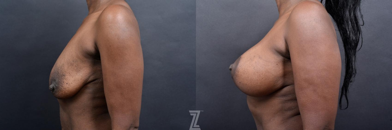 Austin Lateral View of Breasts 1 Year Post-OP Mommy Makeover in Austin, TX by Dr. Rocco Piazza - The Piazza Center