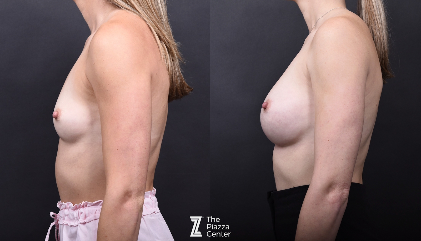Austin Breast Augmentation Side Comparison - The Piazza Center