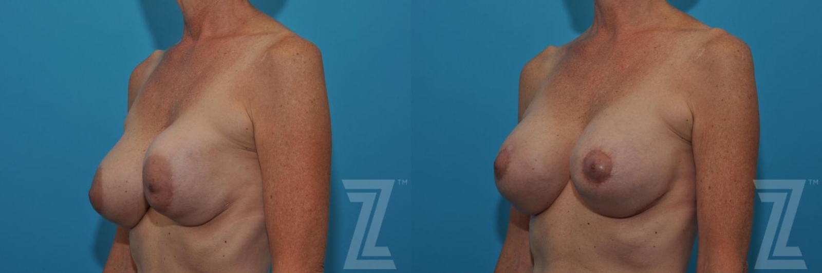 Austin Breast Augmentation Revision Before & After Gallery - Patient 132886537 - Image 2 - The Piazza Center