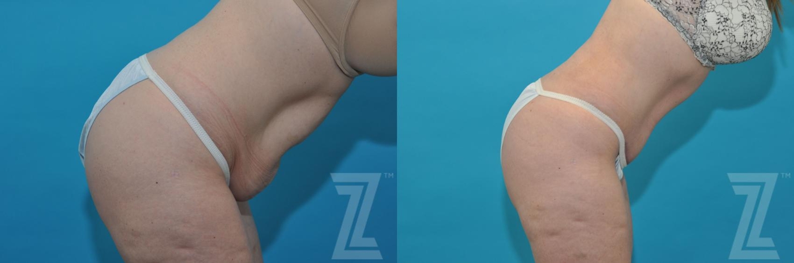 Austin Tummy Tuck Before & After Gallery - Patient 132886814 - Image 5 - The Piazza Center