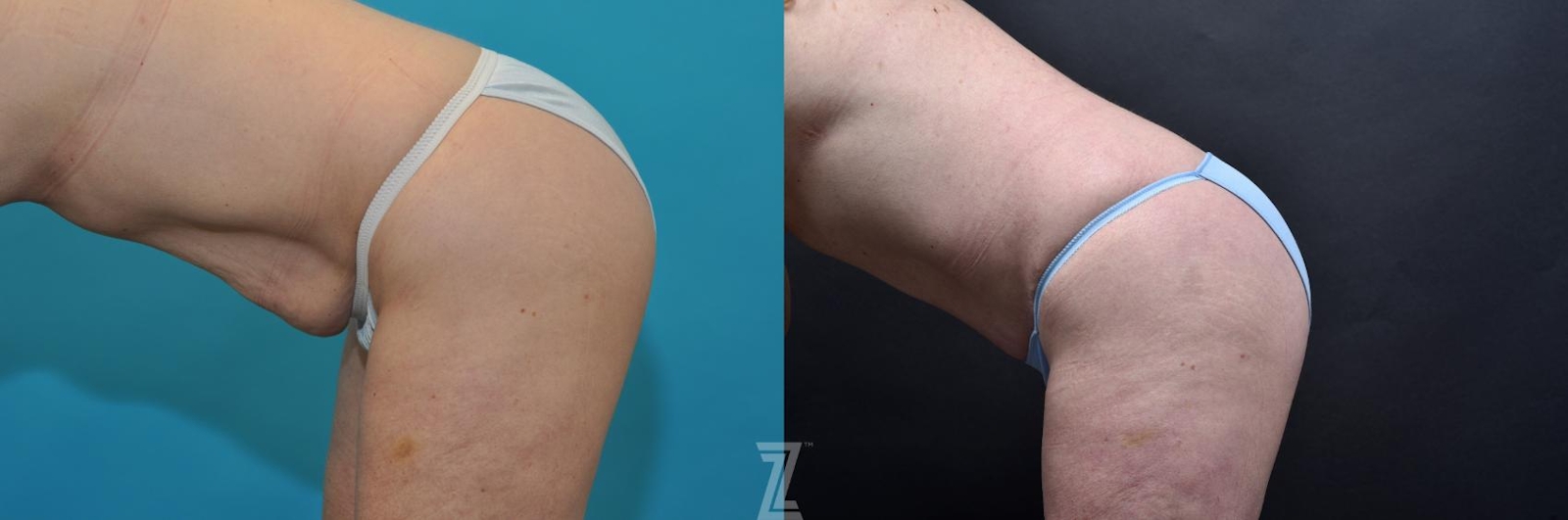Austin 7 year post op mommy makeover oblique flexion view - The Piazza Center, Austin Tx - The Piazza Center