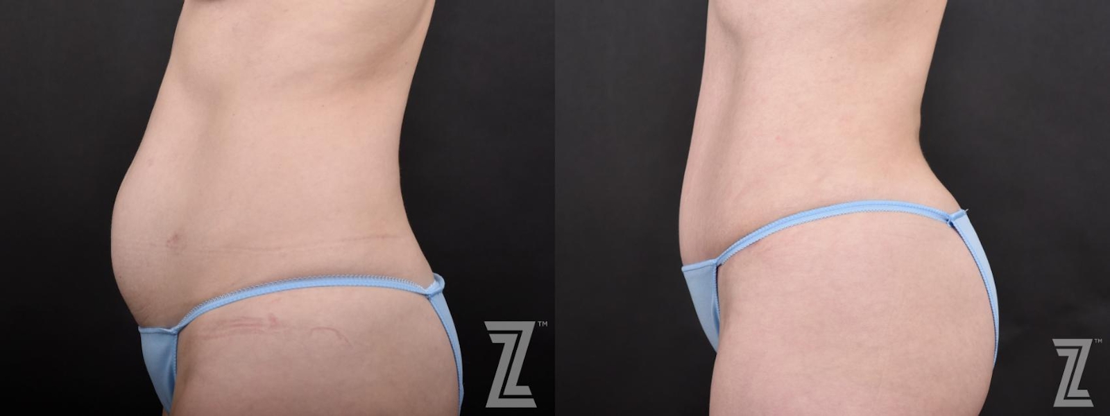 Austin Lateral View of Tummy from Mommy Makeover with Surgical Plan for a Breast Augmentation and a Contoured Waistline With an Abdominoplasty in Austin, TX by Dr. Rocco Piazza - Before & After - The Piazza Center
