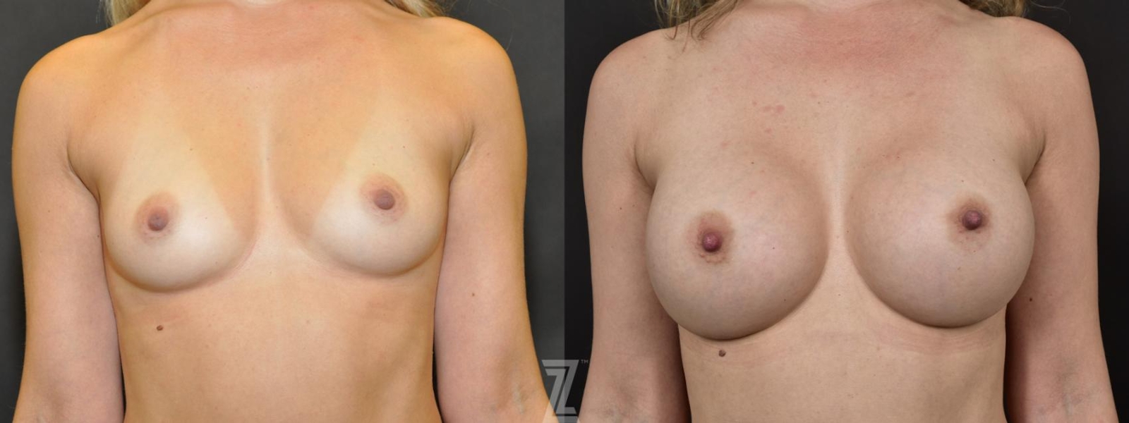 Austin Before & After image of 33 year old woman with Silicone Implants with Cohesive Silicone Gel - The Piazza Center