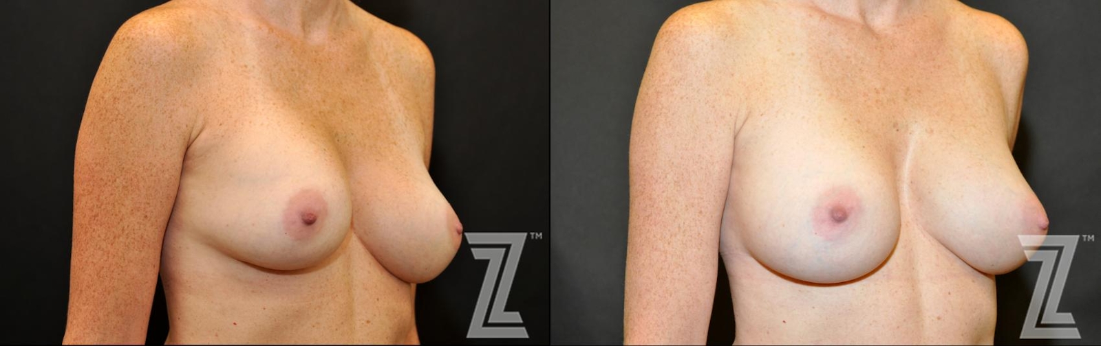 Austin Breast Augmentation Revision Before & After Gallery - Patient 132886587 - Image 4 - The Piazza Center