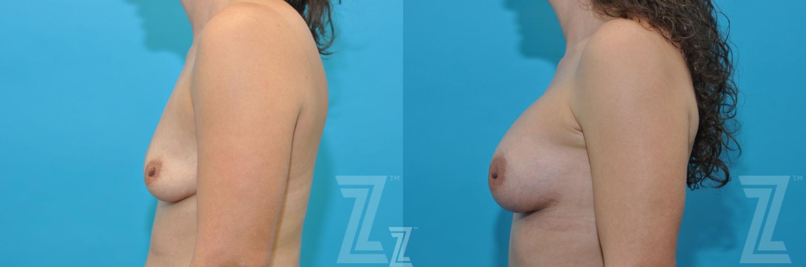 Austin Before & After images side breast view of 40-year-old mother of five mommy maker over - Dr. Rocco Piazza, Austin TX - The Piazza Center