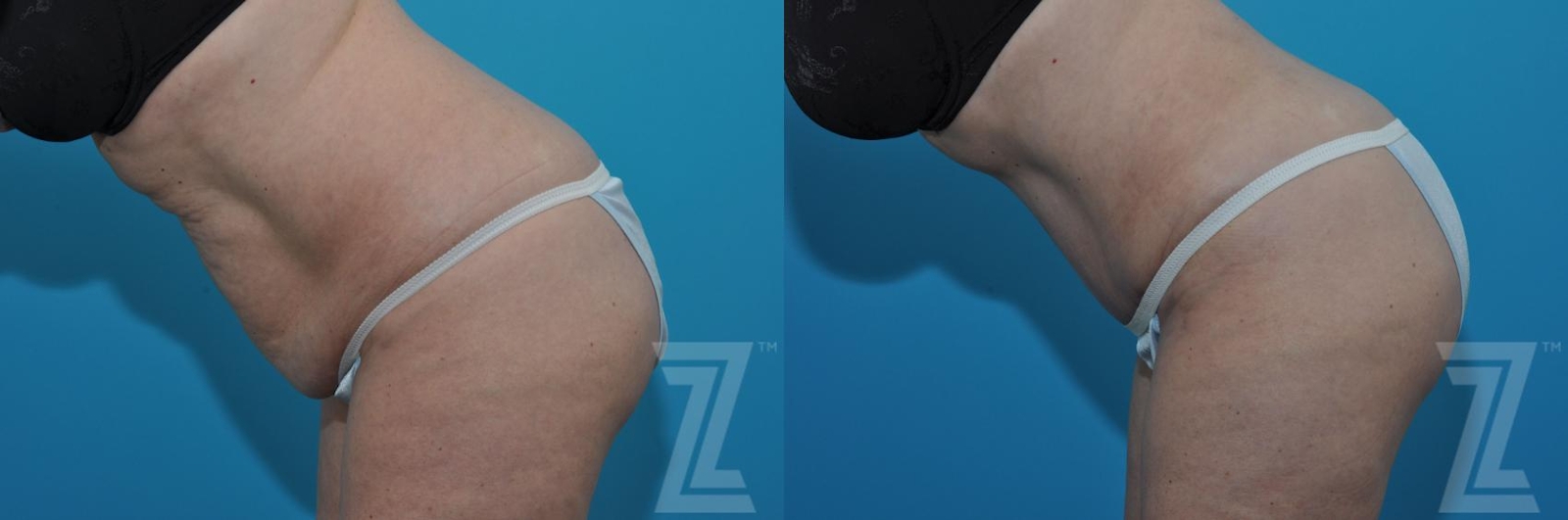 Austin Tummy Tuck Before & After Gallery - Patient 132886903 - Image 3 - The Piazza Center