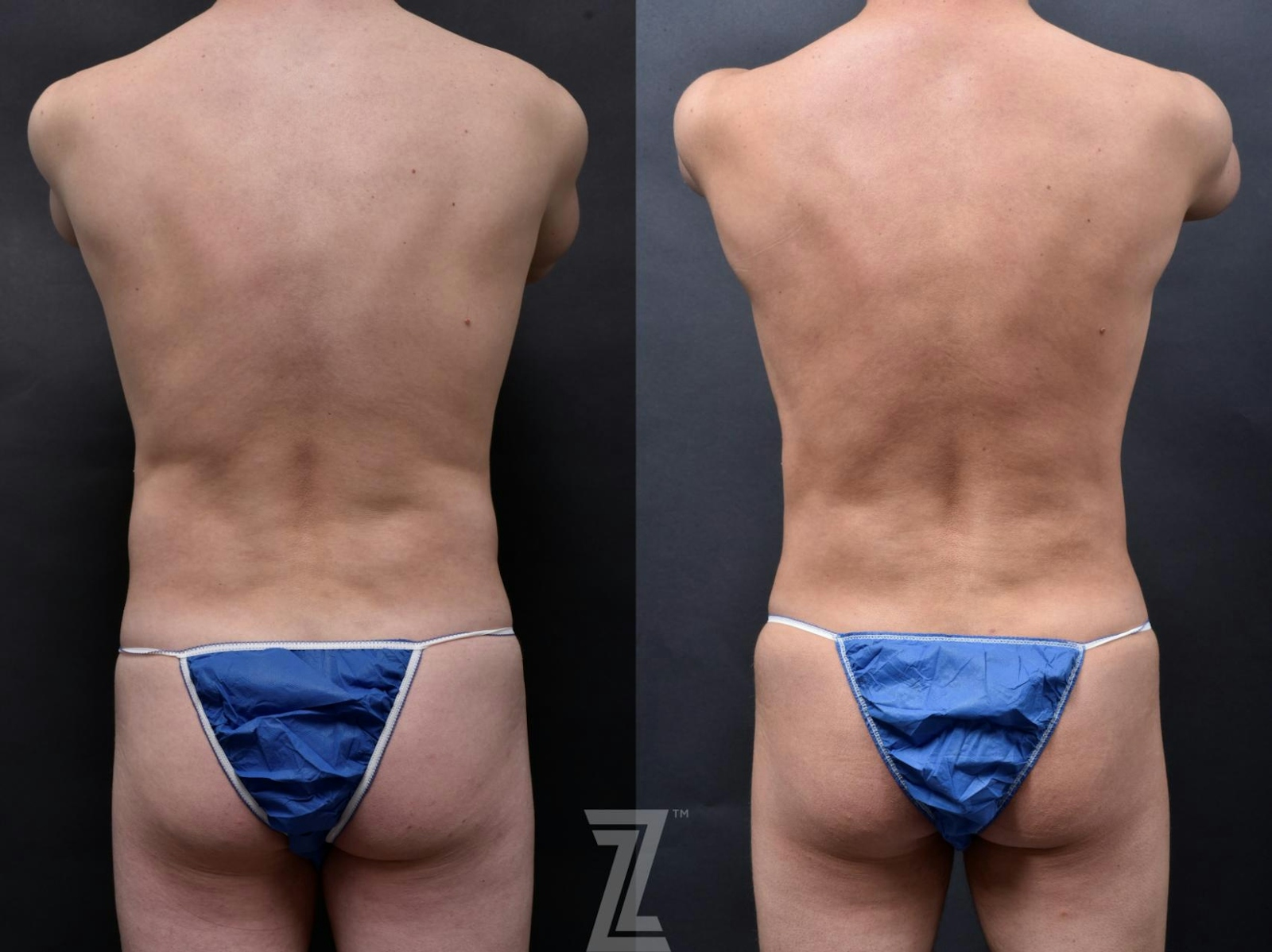 Austin Male Body Contouring Before & After Gallery - Patient 273342 - Image 3 - The Piazza Center