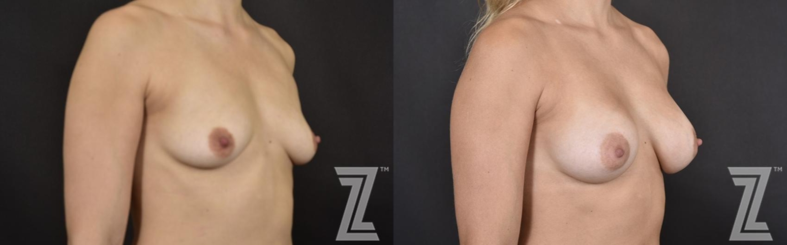 Austin Oblique view before & after images of 32 year old woman with breat augmentation at the Piazza Center - The Piazza Center