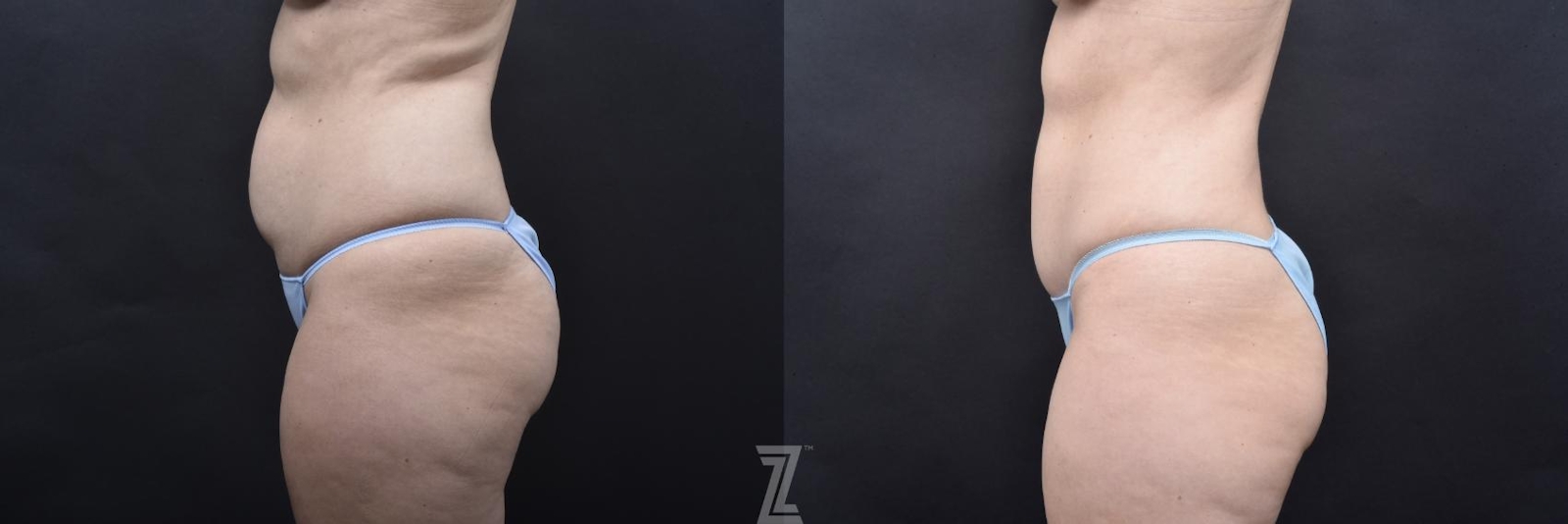 Austin Skin Pinch Before & After Gallery - Patient 132886936 - Image 2 - The Piazza Center