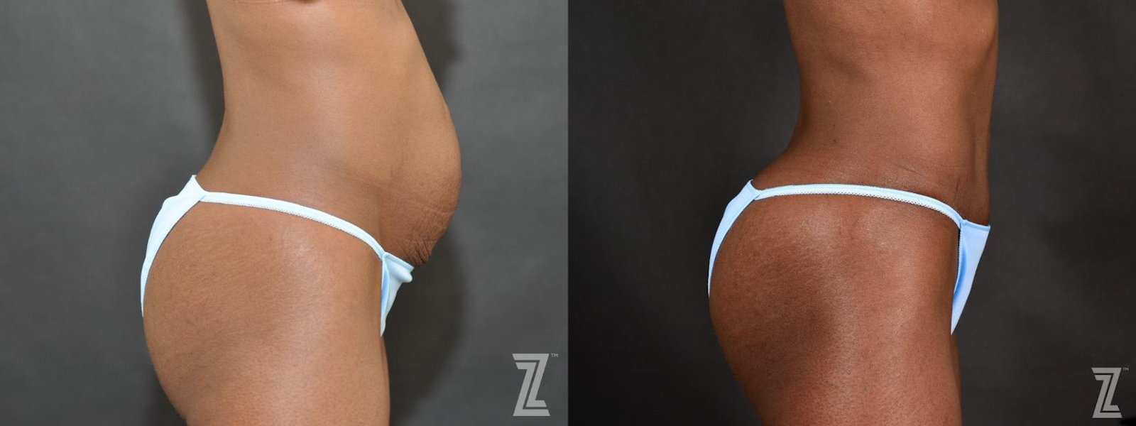 Austin Tummy Tuck Before & After Gallery - Patient 132886804 - Image 3 - The Piazza Center