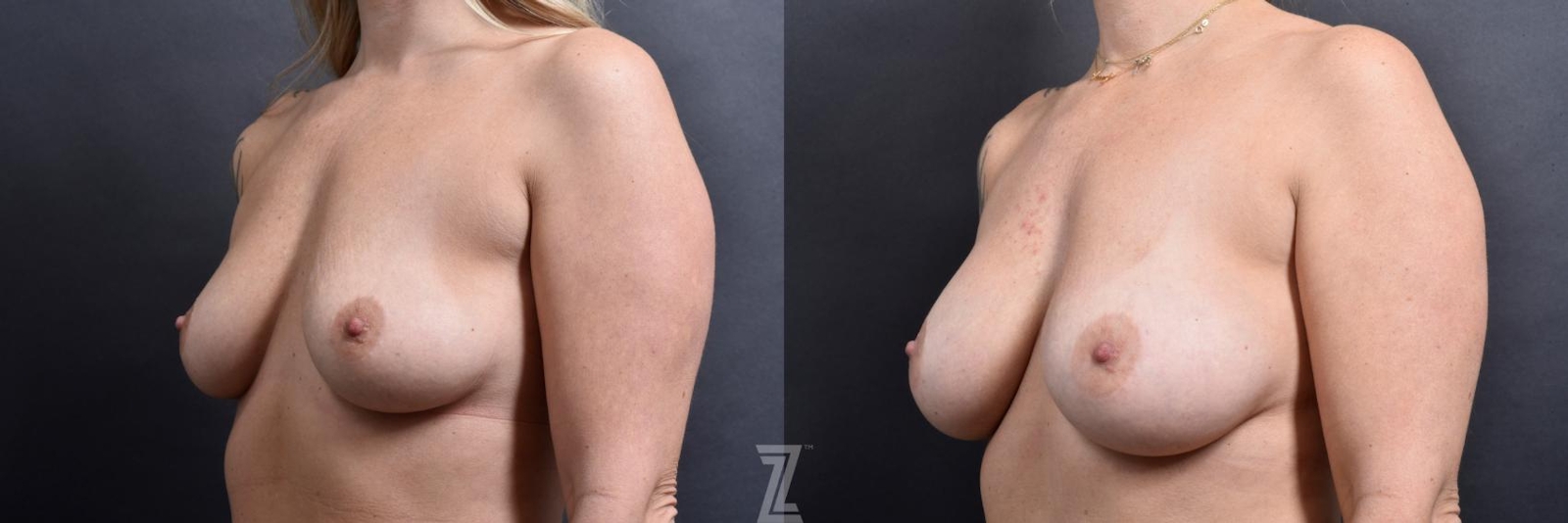 Austin Oblique View of 6 month post op before and after image of 39 year old woman with Silicone Implants with Cohesive Silicone Gel - The Piazza Center