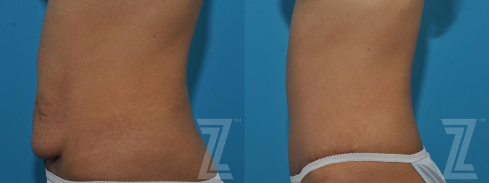 Austin Tummy Tuck Before & After Gallery - Patient 132886797 - Image 3 - The Piazza Center
