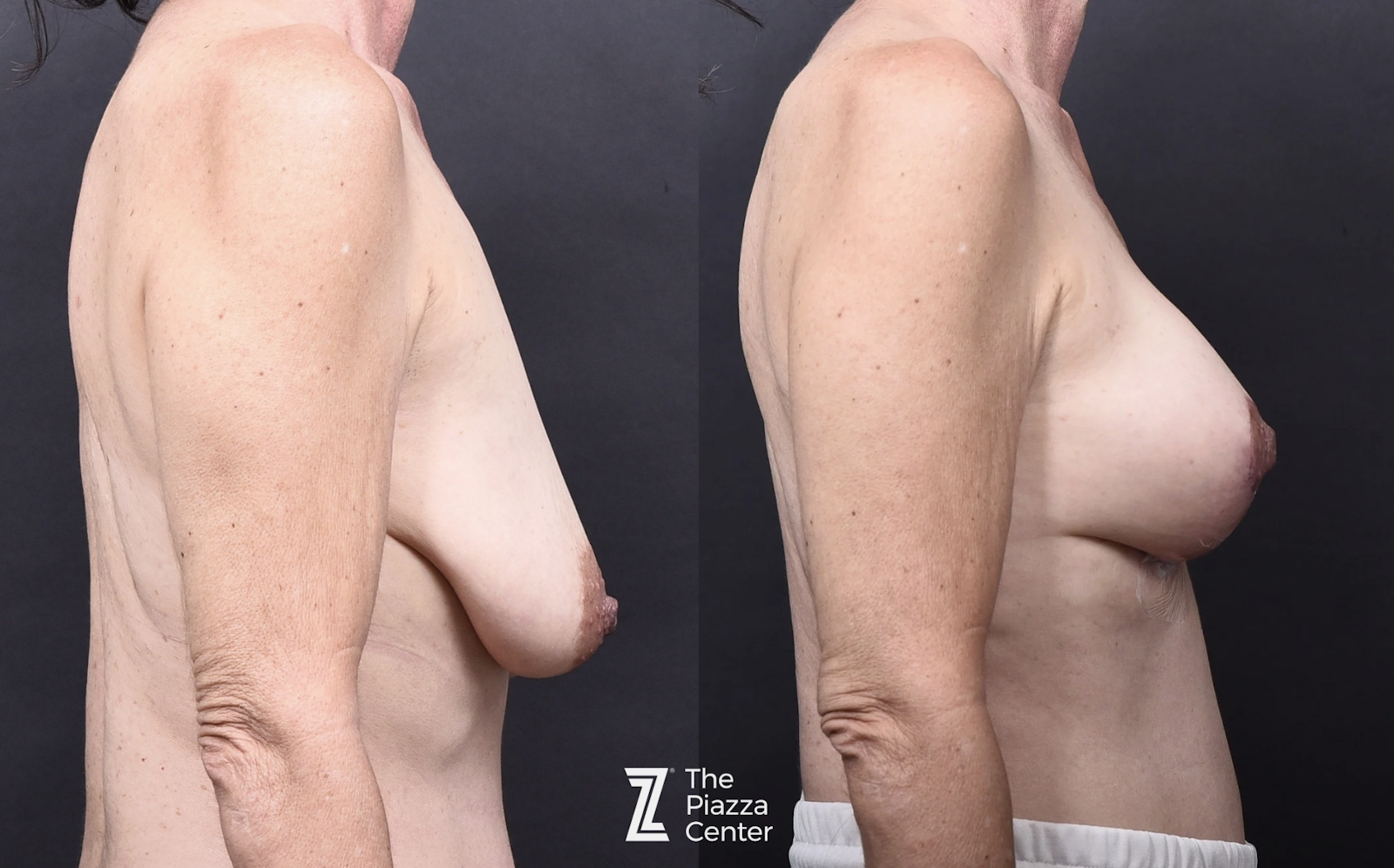 Austin Breast Augmentation With a Breast Lift - The Piazza Center