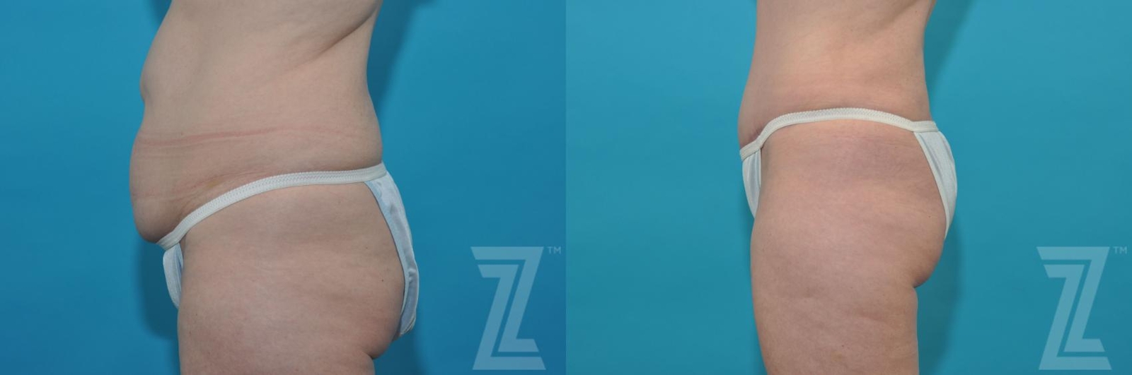 Austin Tummy Tuck Before & After Gallery - Patient 132886814 - Image 2 - The Piazza Center